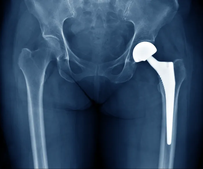 What Is a Total Hip Replacement?