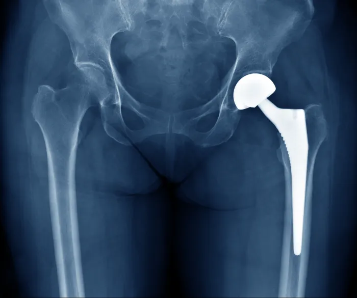 osteoarthritis hip replacement