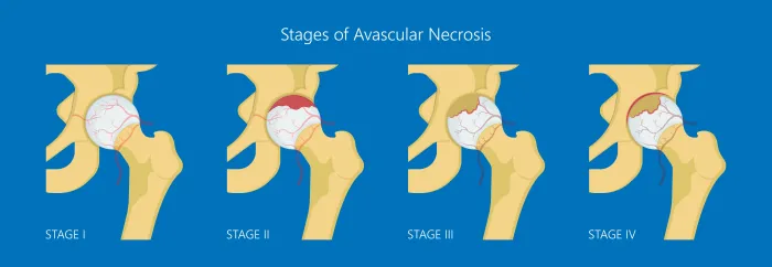 What Is Avascular Necrosis (Osteonecrosis)?