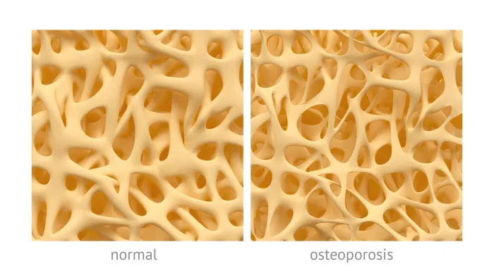 What is osteoporosis?