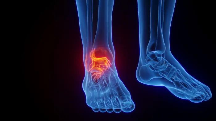 What Is Ankle Syndesmosis (or High Ankle Sprain)? 