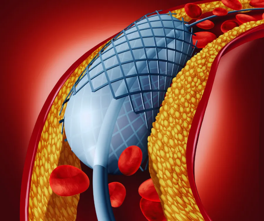 Medical illustration of a stent opening a clogged artery with red blood cells flowing through.