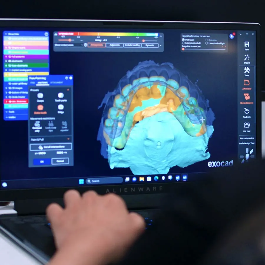 3D dental model displayed on a laptop screen with user interface for design software.