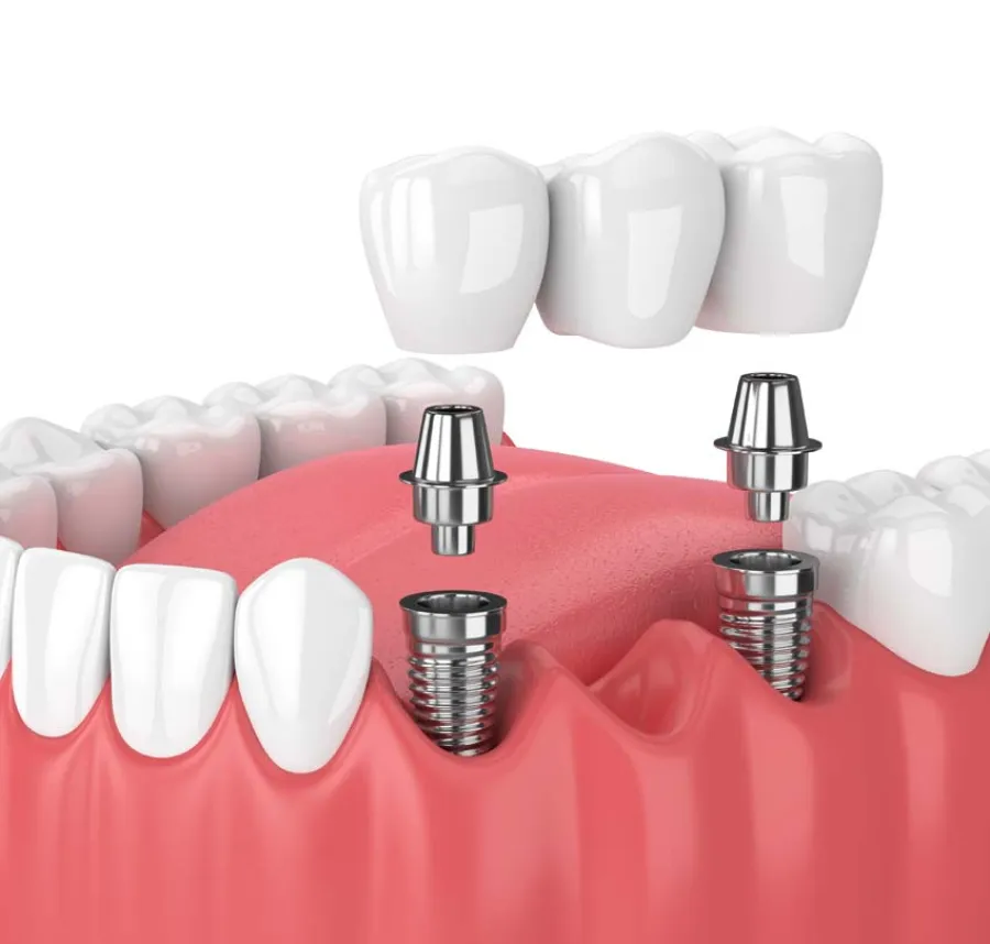 3D illustration of dental implants with abutments supporting a three-unit dental bridge on pink gums.