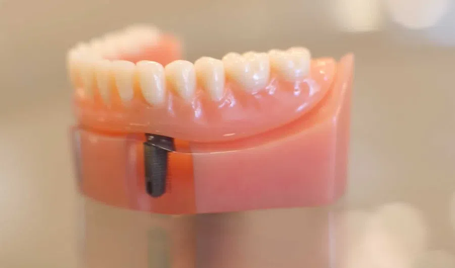 Close-up of dental implant model showing artificial teeth and titanium screw in gum-colored base.