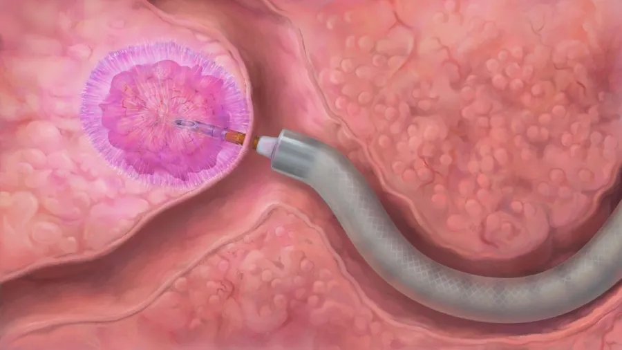Medical illustration of a biopsy needle extracting tissue from a pink internal organ section.
