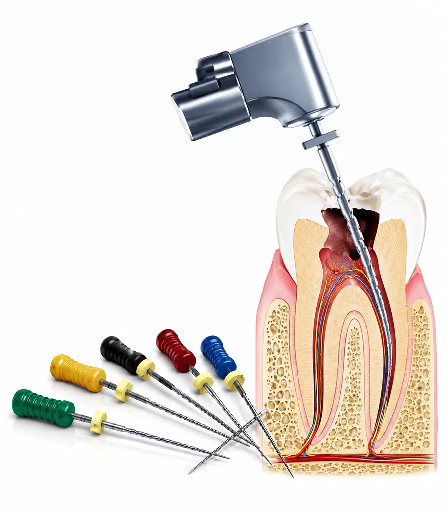 Endodontic files and dental drill used for root canal treatment shown with a tooth cross-section and infection.