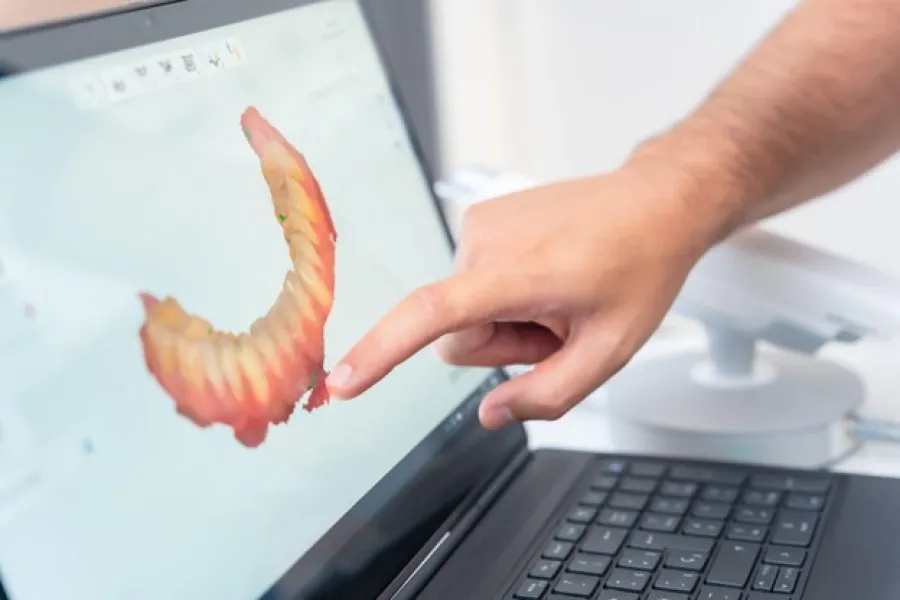 Person interacting with digital 3D dental scan displayed on a laptop screen for dental analysis.
