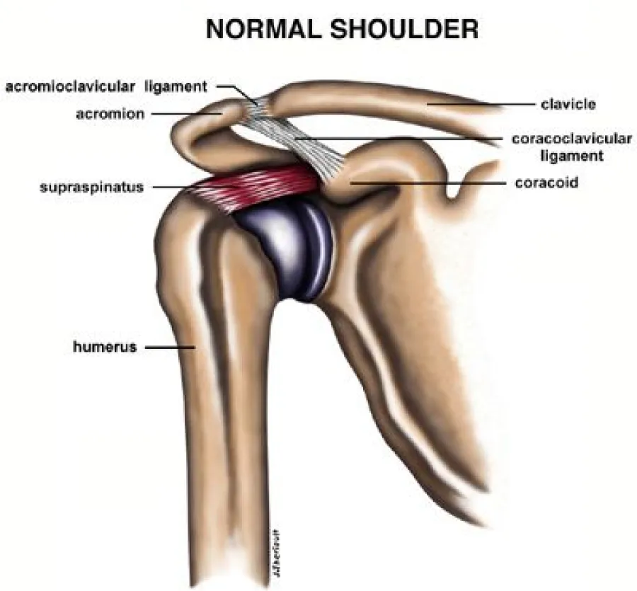 Diagram of a normal shoulder showing clavicle, humerus, ligaments, supraspinatus muscle, and acromion bone.