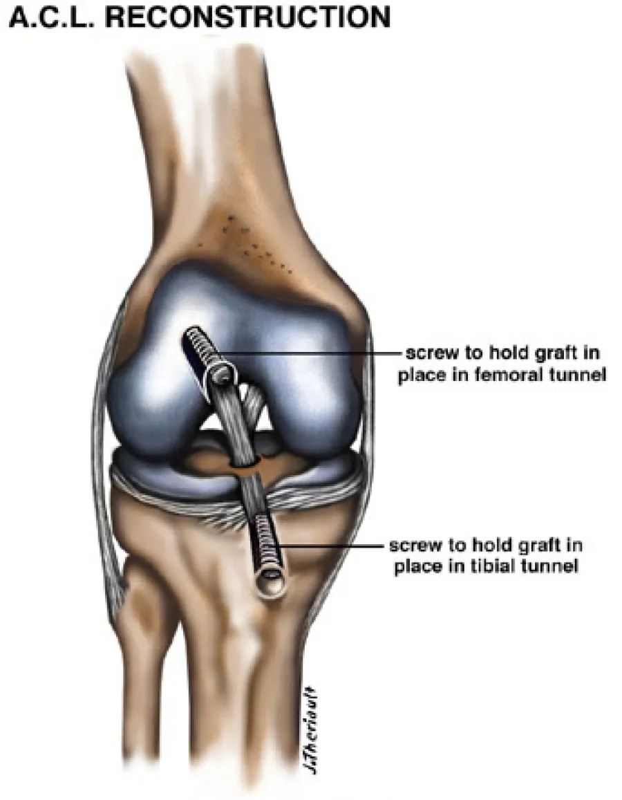 Diagram of ACL reconstruction showing screws holding graft in femoral and tibial tunnels of knee joint.