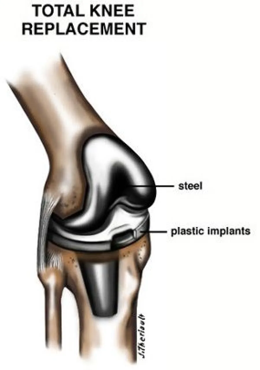 Diagram of total knee replacement showing steel and plastic implant components in the joint.