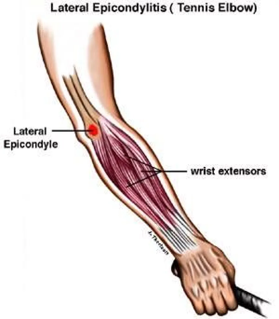 Illustration of lateral epicondylitis showing wrist extensor muscles and lateral epicondyle on the forearm.