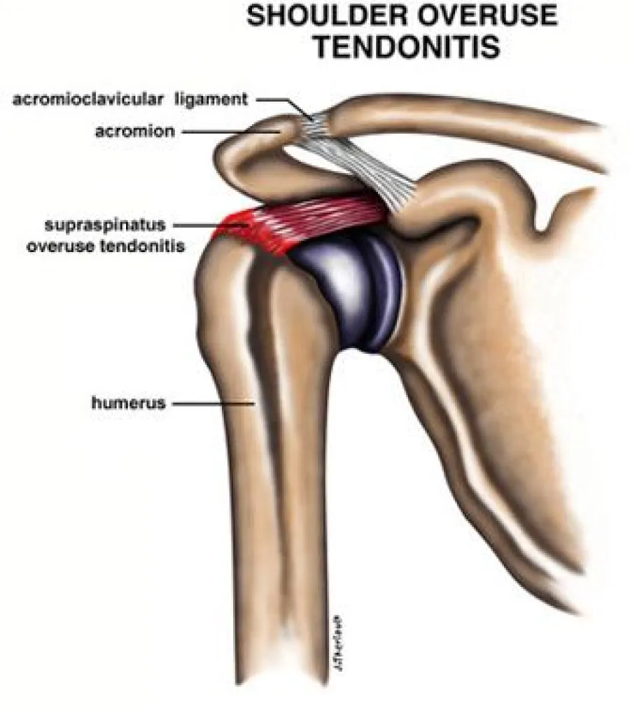 Anatomical diagram of shoulder showing overuse tendonitis in supraspinatus tendon and key labeled parts.