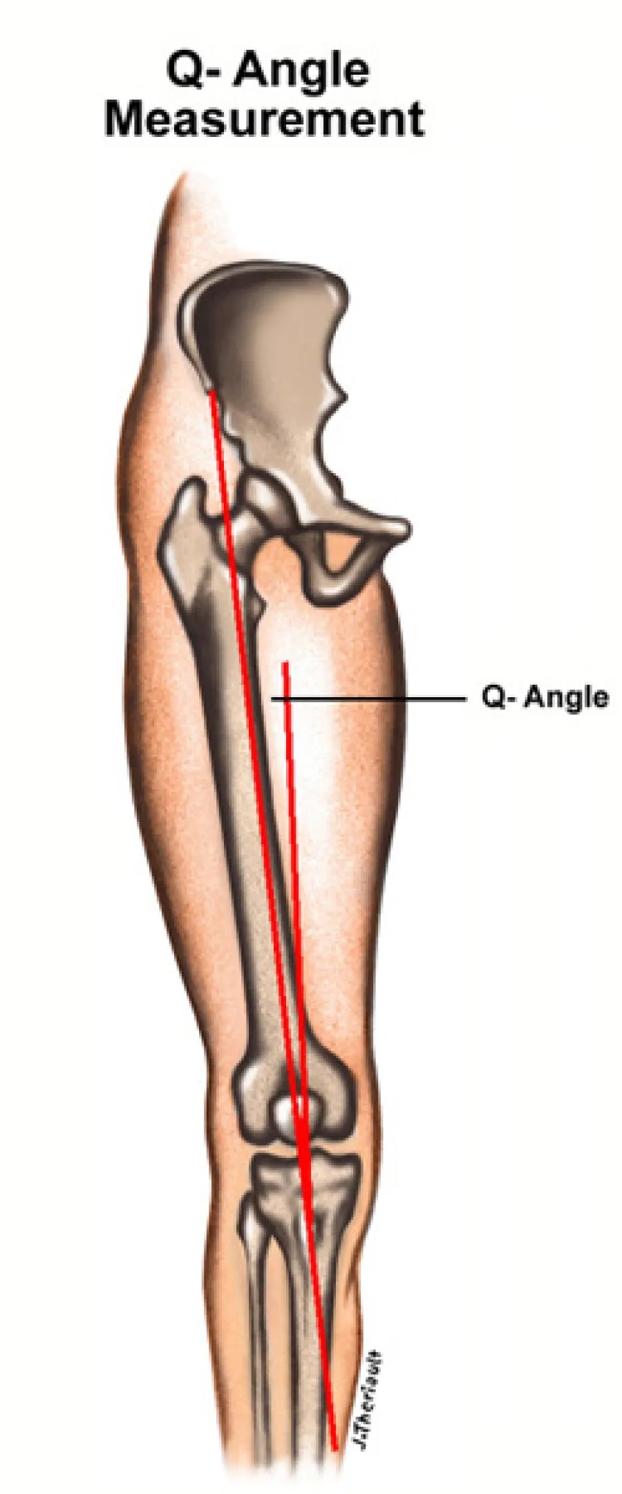 Illustration showing Q-angle measurement in the human leg with red lines and labeled bones.