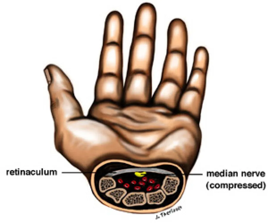 Illustration of a hand cross-section showing compressed median nerve and retinaculum causing carpal tunnel syndrome.