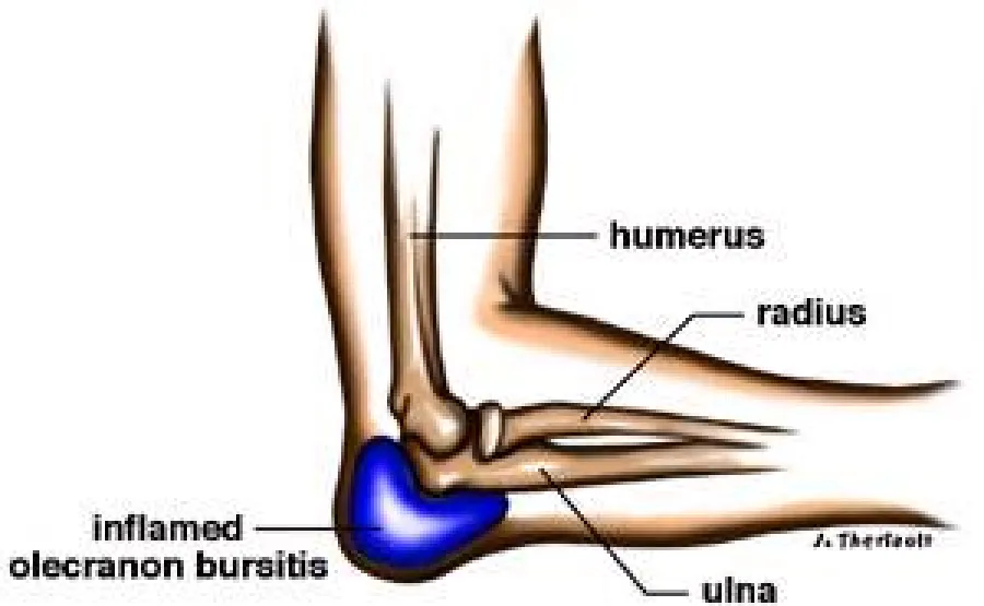 Diagram showing the elbow bones with inflamed olecranon bursitis highlighted in blue.