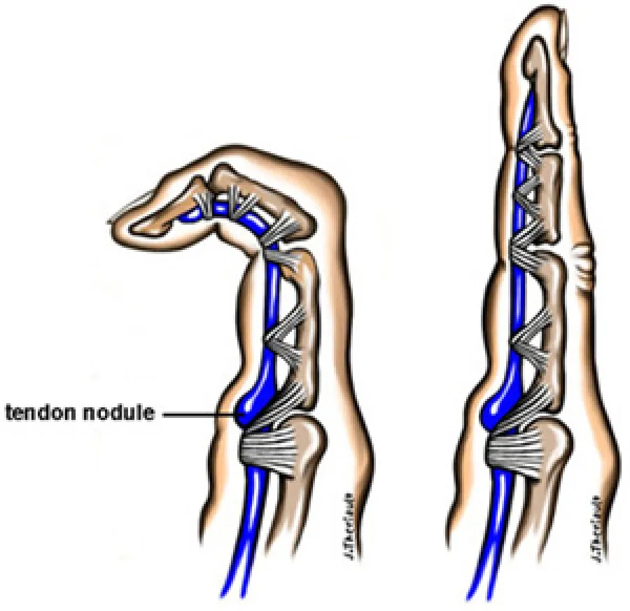Diagram of finger showing tendon nodule and tendon anatomy in bent and straight positions.