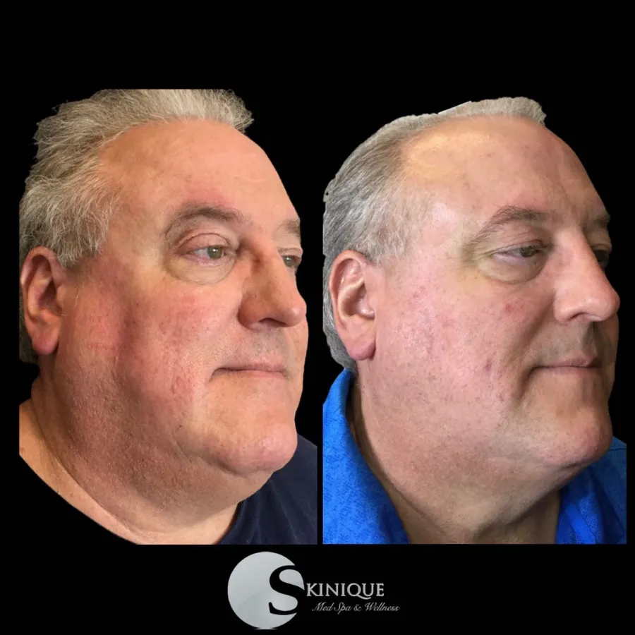 Coolsculpting chin results
